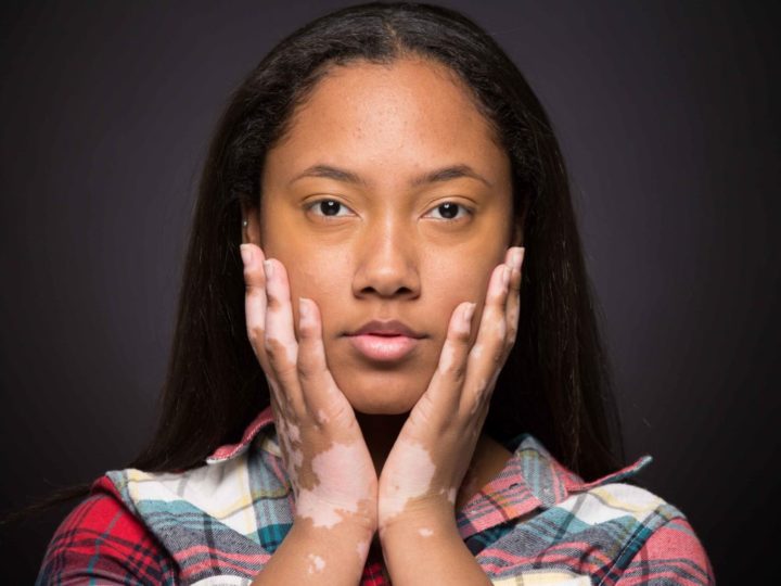Weighing-In: The Experts Talk Vitiligo